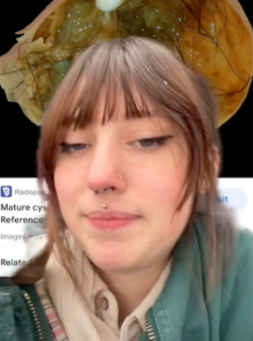 Page讓觀眾自行斟酌是否要看皮樣囊腫。