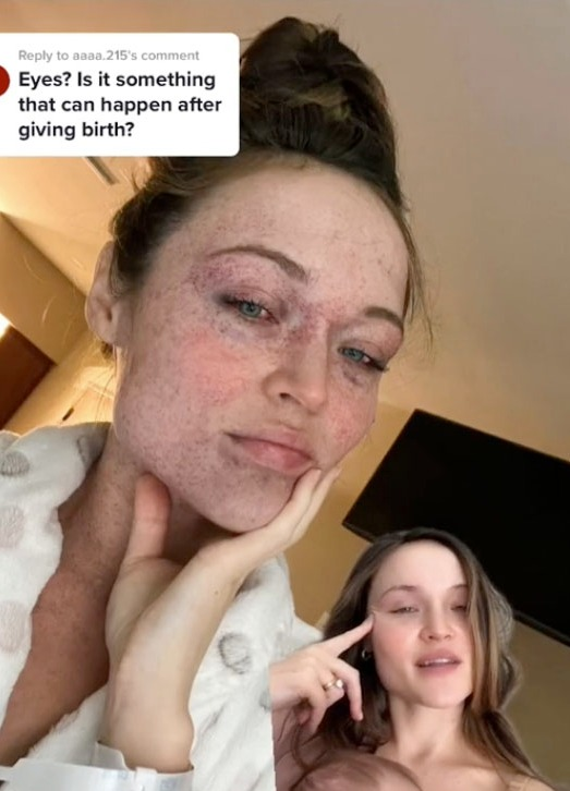 Yelena像生產時疑用錯力，令頭項眼都出現爆微絲血管的情況。