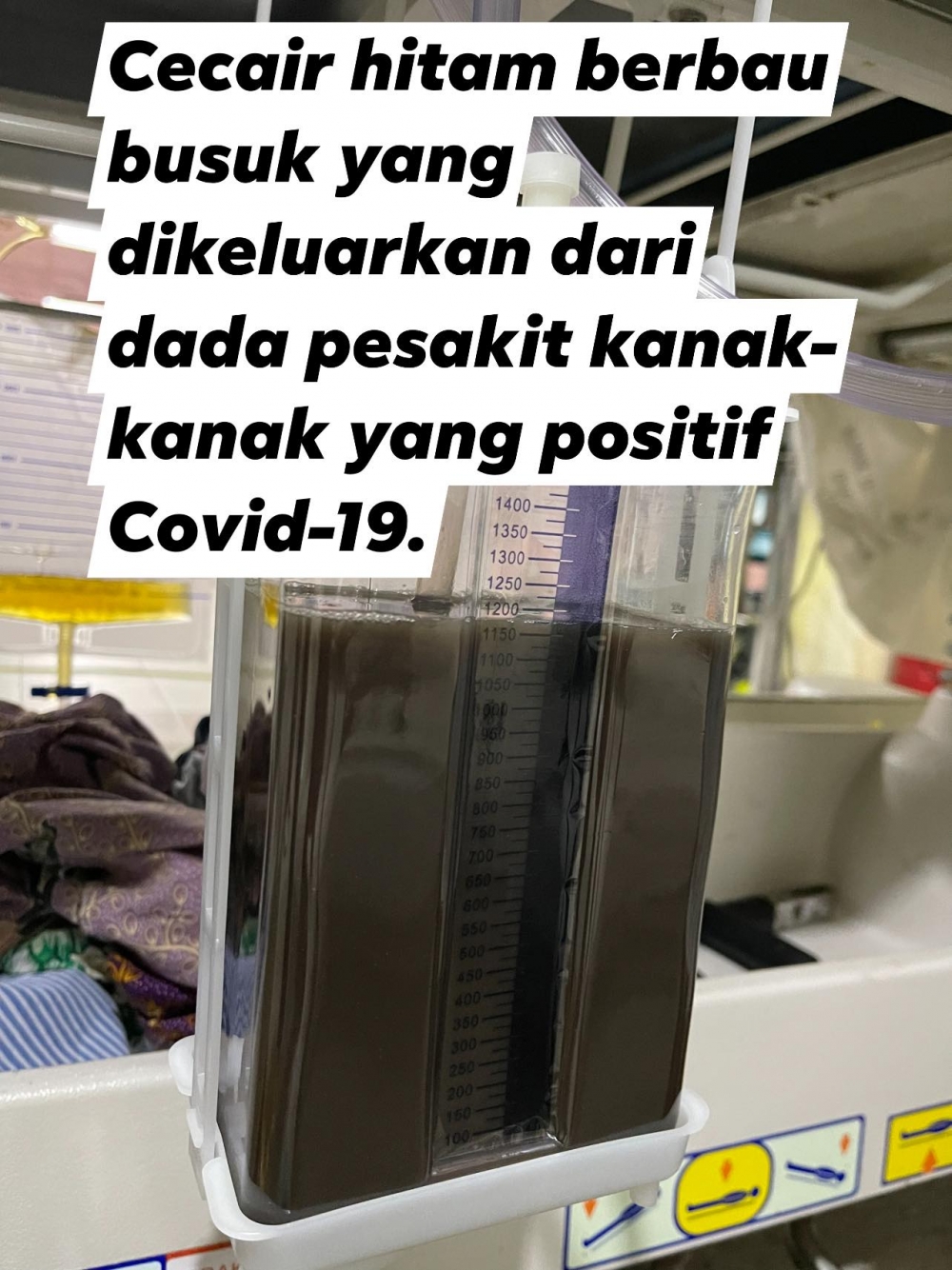 馬來西亞醫生分享救治確診兒童經歷，表示一名重症小患者體內抽出將近一公升黑臭液體。