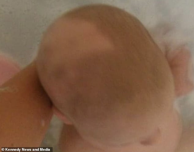 嬰兒時期胎記非常明顯。