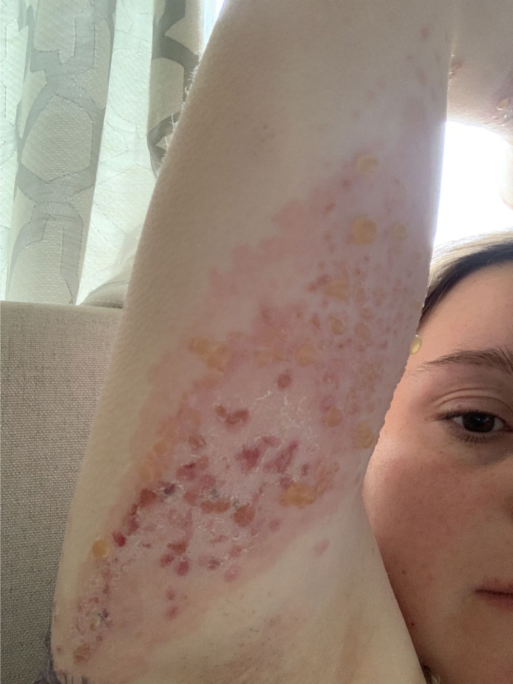 Fiona身體各算都出現嚴重過敏。