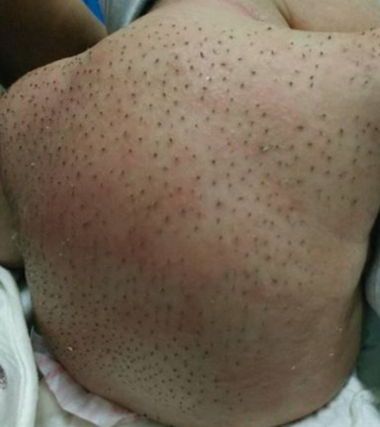 內地一位媽媽驚覺，BB身上長出大量離奇黑色斑點。