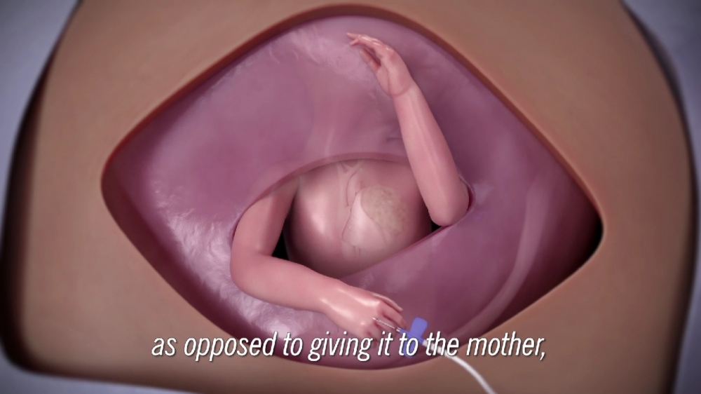 醫生要在胎兒的右臂,插入靜脈輸液管。