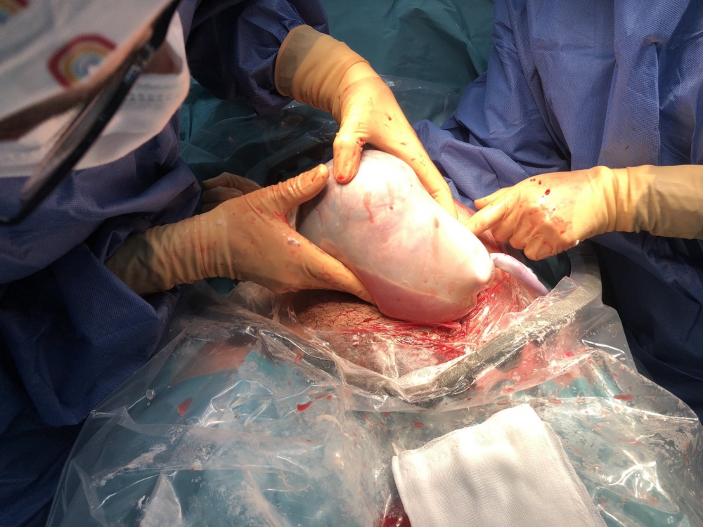 西班牙有一對「人魚雙胞胎」誕生。