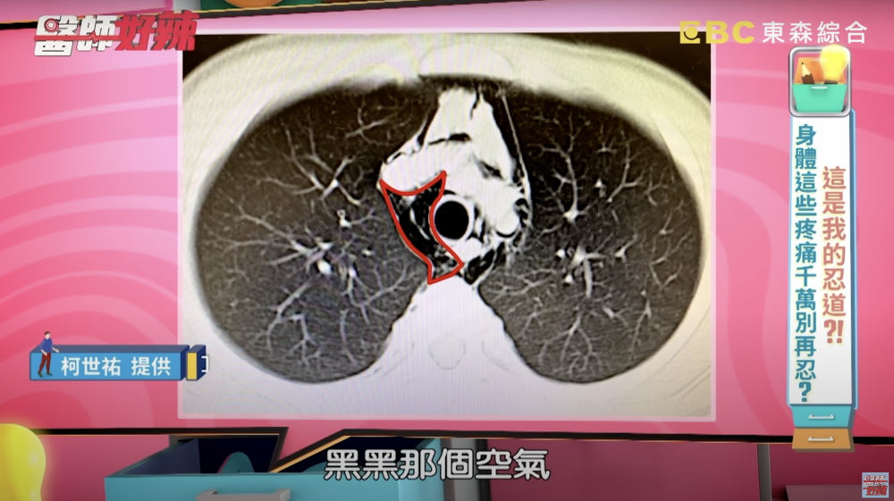 柯醫生解釋,忍噴嚏時胸腔壓力太大,可導致肺泡中的空氣從小傷口跑到皮下及縱膈腔。