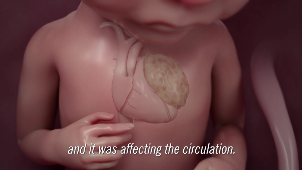 媽媽產檢時,不幸發現發現胎兒的心臟長有腫瘤。