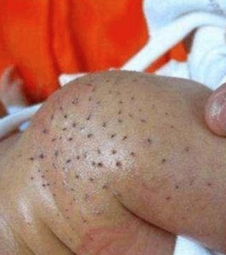 媽媽直言，孩子的斑點看上去就像豬毛，情況非常嚇人。