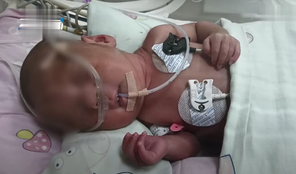 現時一對寶寶每日都要使用呼吸機，並透過輸血、輸氧氣及營養液來維生。