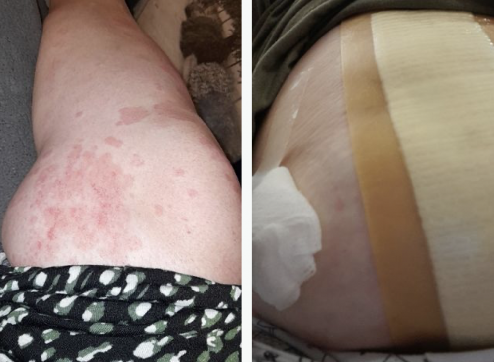 雖然Sarah的手術成功,但腫瘤還未被全數清除,Sarah還需要再接受觀察和治療。左圖為佈滿紅疹的雙腿。