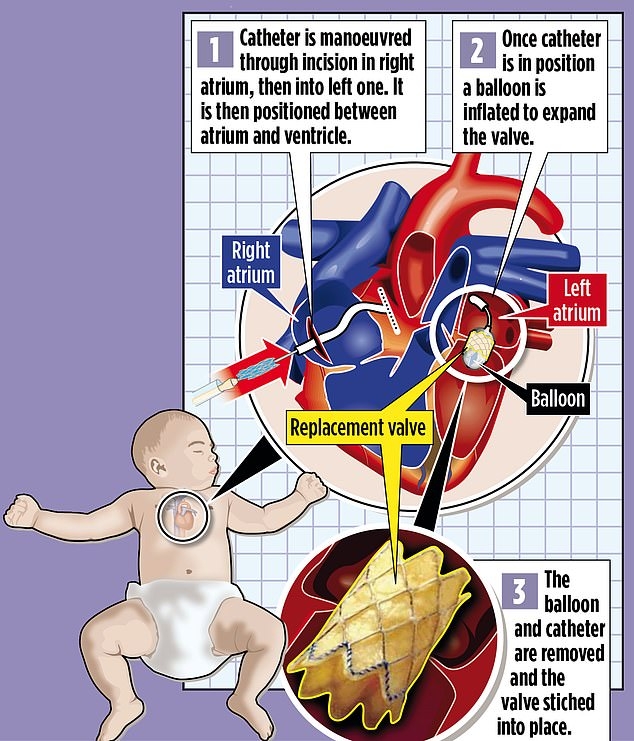 「Melody valve」技術，是利用經過嚴格測試的牛頸靜脈瓣膜製成可調節大小的瓣膜，再植入到心臟內。