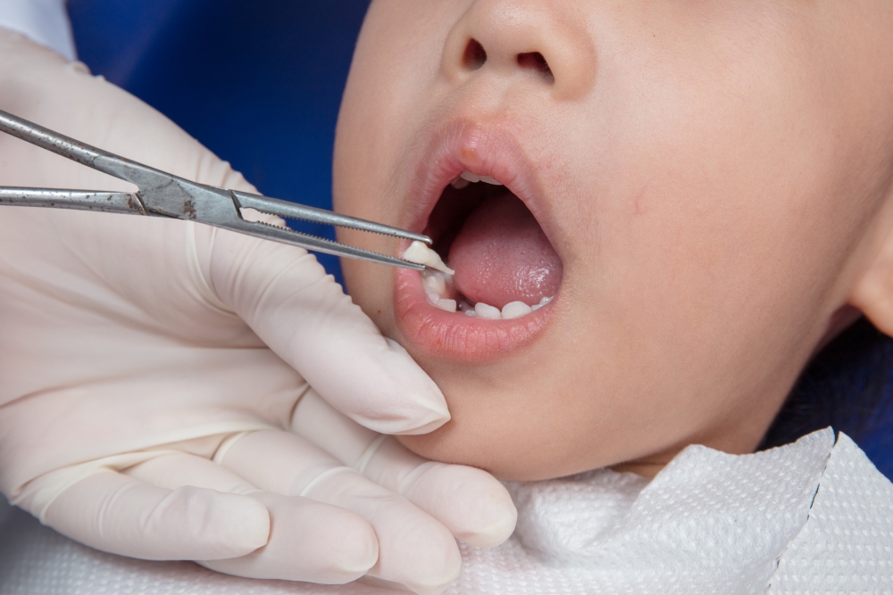 5歲華裔男童因為吃太多糖而導致門牙蛀牙，所以父母安排他到醫院進行剝牙。