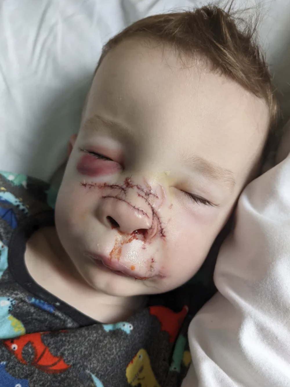 Romy不但下巴骨折、鼻子被咬裂,他更被扯掉了3顆牙齒,並縫了過百針,整張臉都留下深深的疤痕。