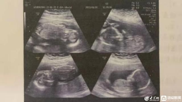 內地一名四胞胎孕婦要分數天生產。