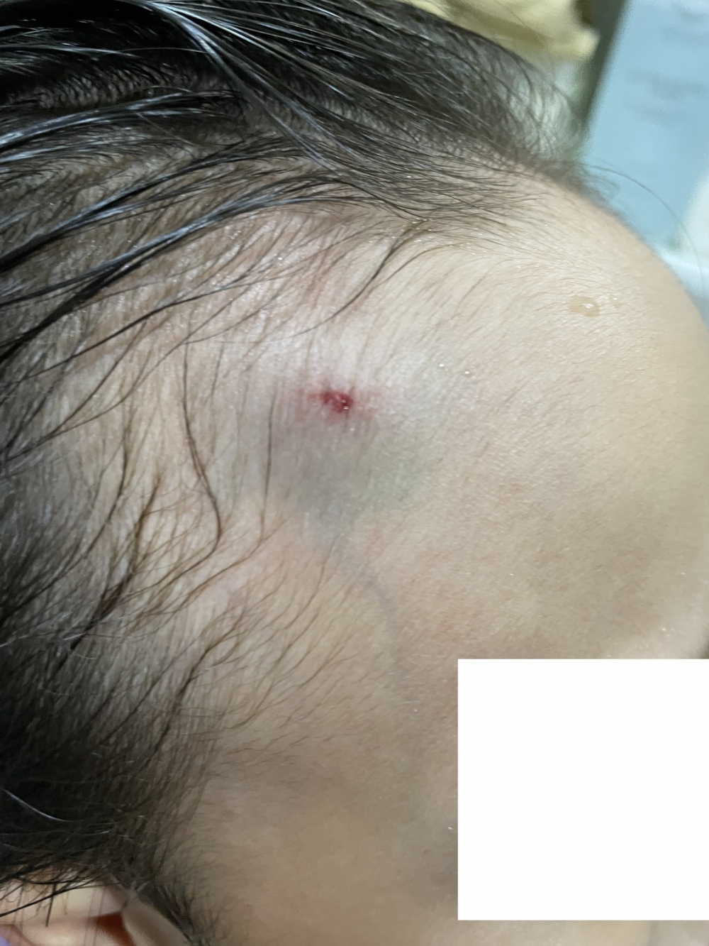 兒子被打後，額頭出現瘀傷。