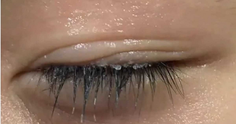 媽媽用冷水幫兒子清洗，又用濕毛巾幫兒子敷眼，沒想到這個行為卻令情況惡化。