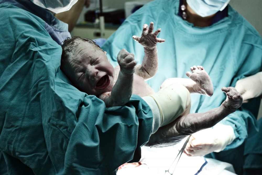 變性女性分娩時只能進行剖腹產。