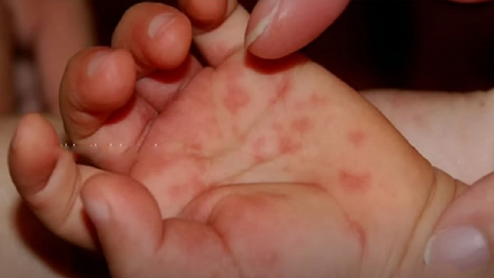 患者全身長滿紅色水泡，有專家認為，這種疾病可能與柯薩奇病毒引起的手足口病相關。