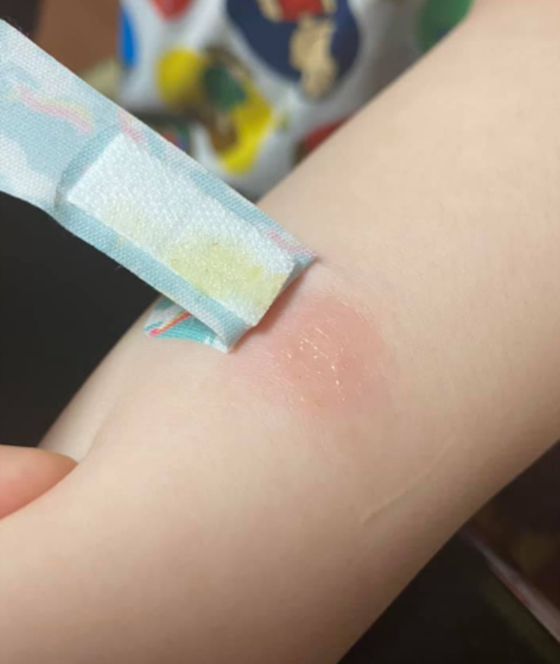 沒想到水晶波中波爆炸,灼傷兒子手臂。