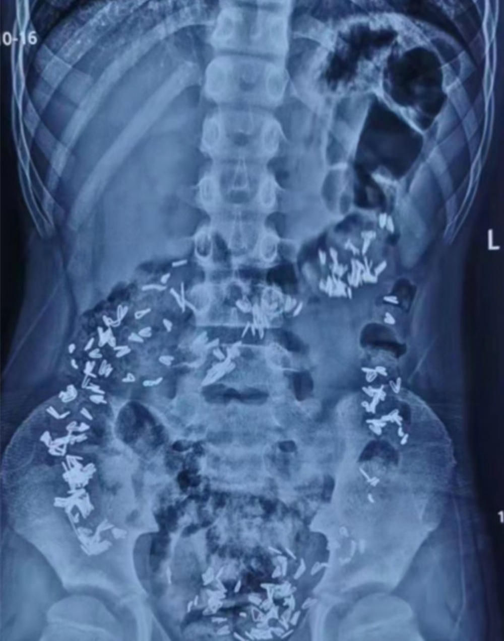 男童的X光照片嚇壞醫生。