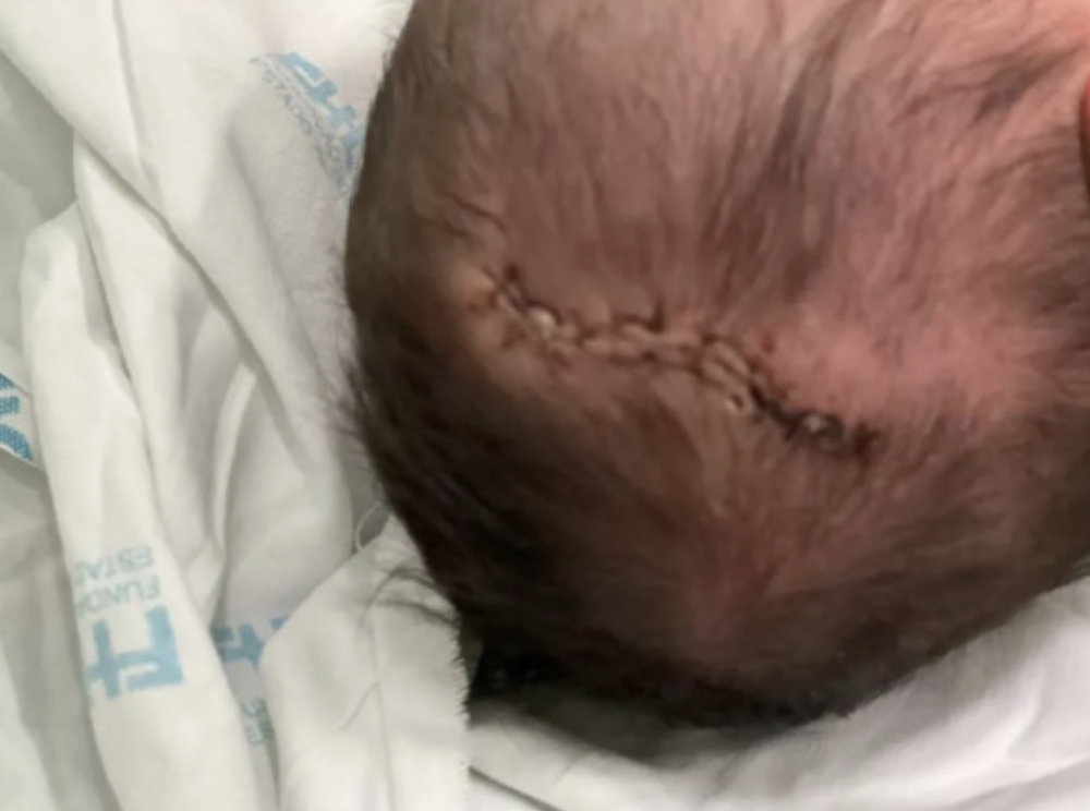 剛出世的女嬰最終因墜地而頭部嚴重受傷，需要縫上11針。
