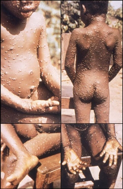 猴痘疫情最初在非洲國家流行起來。
