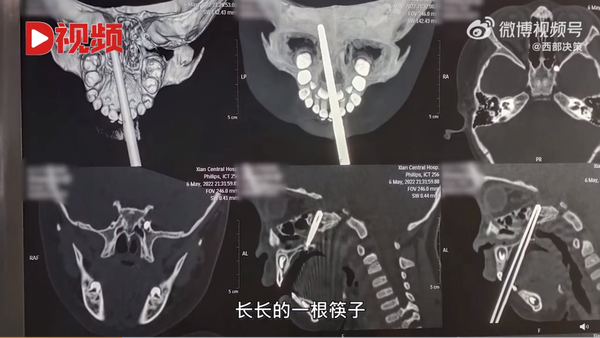 不慎跌倒令筷子直插口腔。