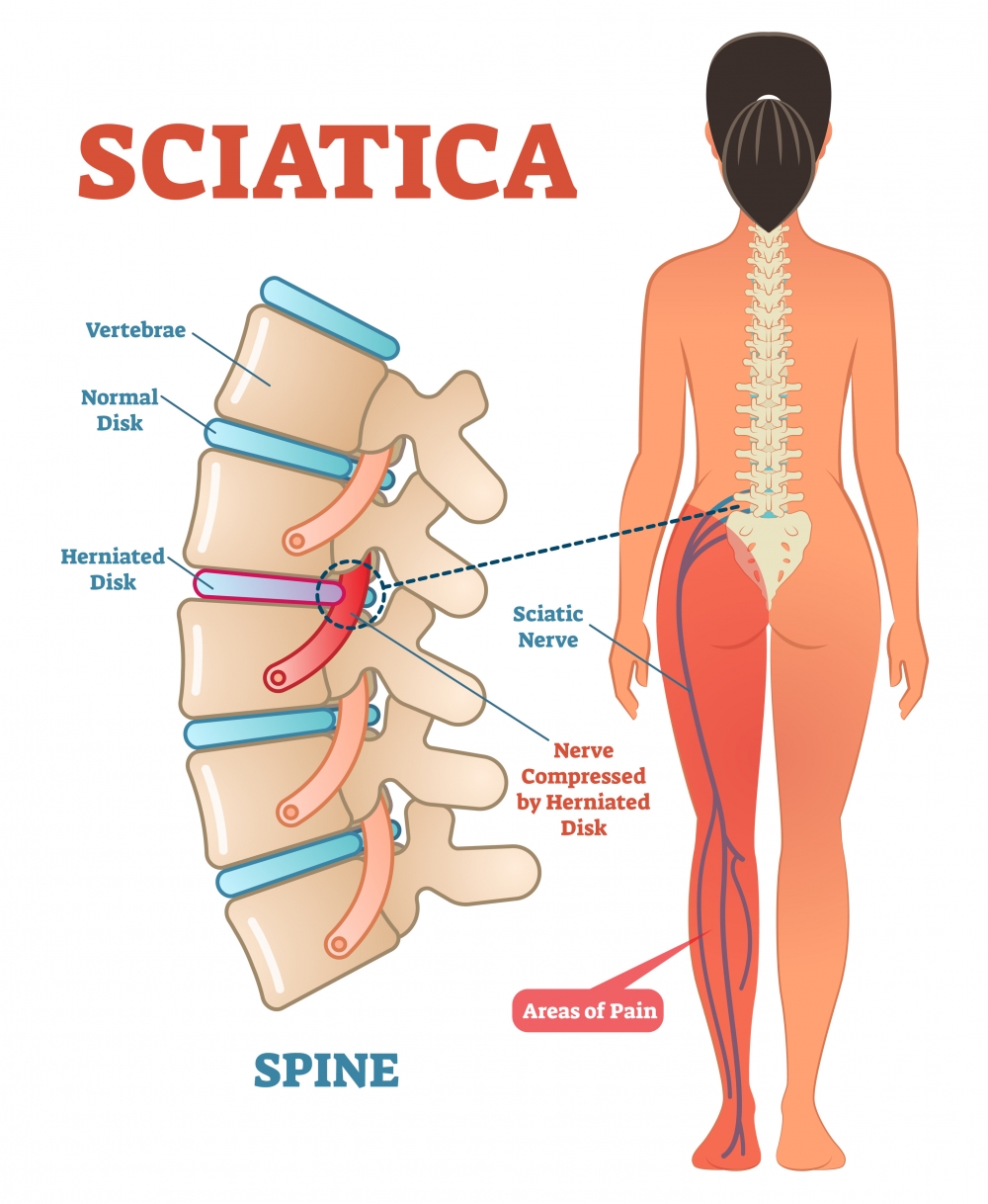 腰椎第四、五節神經線及薦椎第一、二、三節神經線，通過腰位置，再經過坐骨位置，然後黏附在一起，統合稱之為坐骨神經