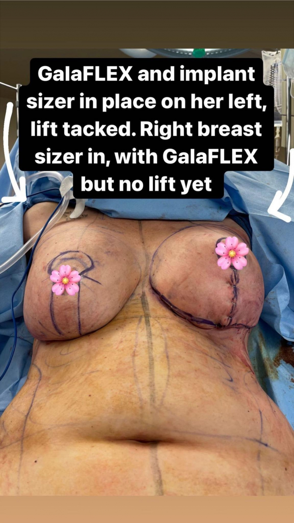 整形項目包括隆胸、抽脂等。