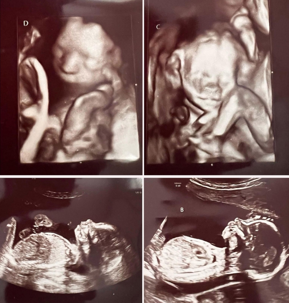 產檢時Ashley才發現懷上2對同卵雙胞胎，機率是七千萬分之一。