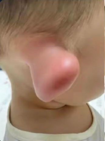 家長在網上分享孩子耳朵過敏的情況。