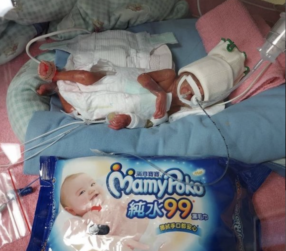 超級早產女嬰小葶的體重僅有370克，大小致賀一包濕紙巾一樣大，因此被稱為「巴掌仙子」。