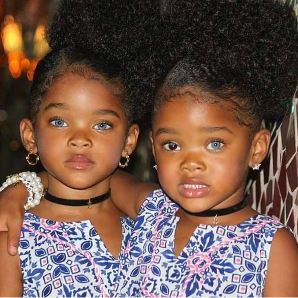 非裔雙胞胎天生擁有藍眼睛,妹妹更是擁有罕見的異色瞳。