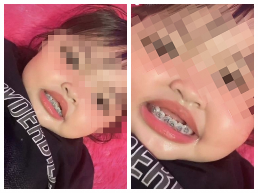 女童下排牙齒明顯戴了牙箍。