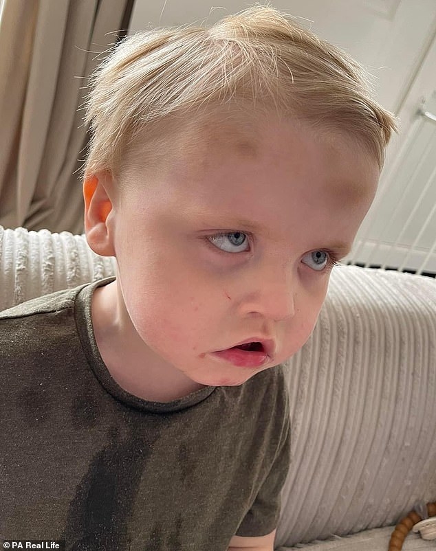 Ronnie罹患罕見病,無法感知痛覺,常出現自殘行為導致滿身傷。