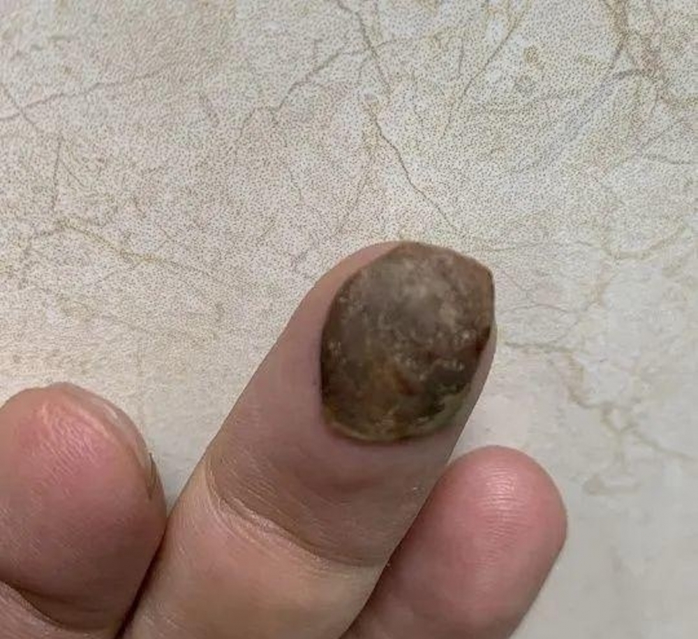 該黑色腫瘤實質是蓮子殼。