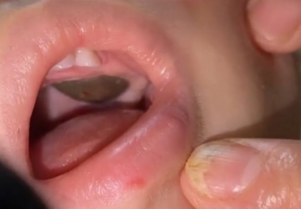 內地日前有一對父母發現11個月大的兒子口腔內出現黑色硬塊。
