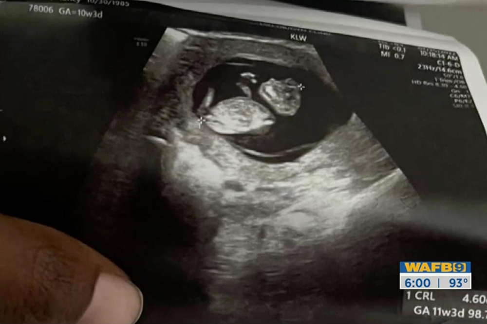 醫生發現胎兒罹患罕見先天性無腦異形。