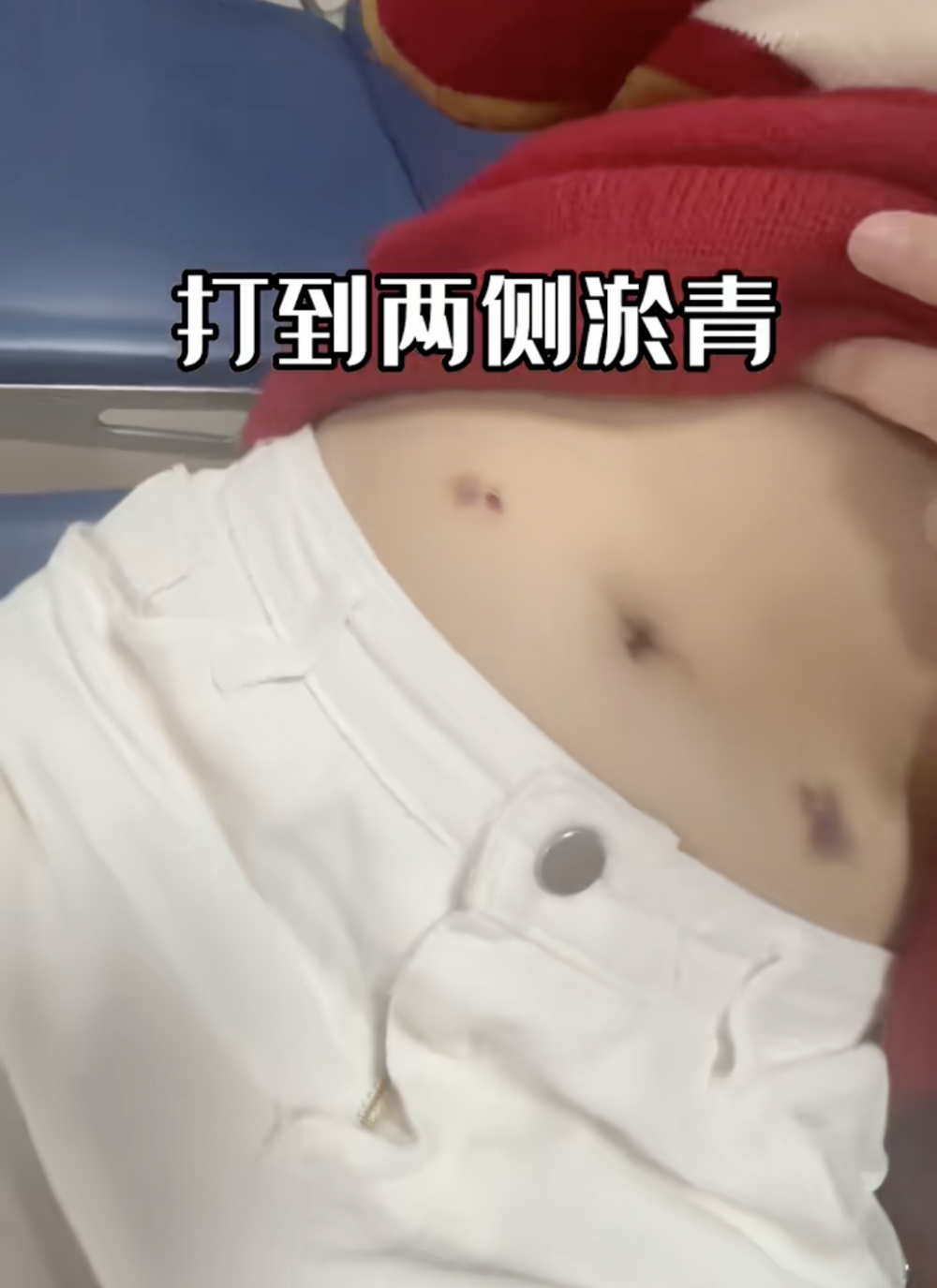 肚皮都是打針留下的痕跡。