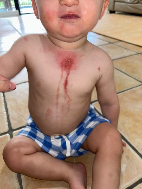 幾日後，皮膚開始起水泡。