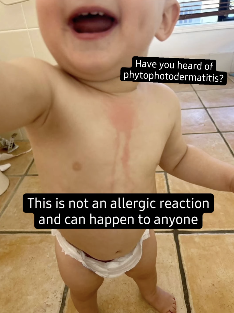 男童的皮膚最初只呈現紅痕。