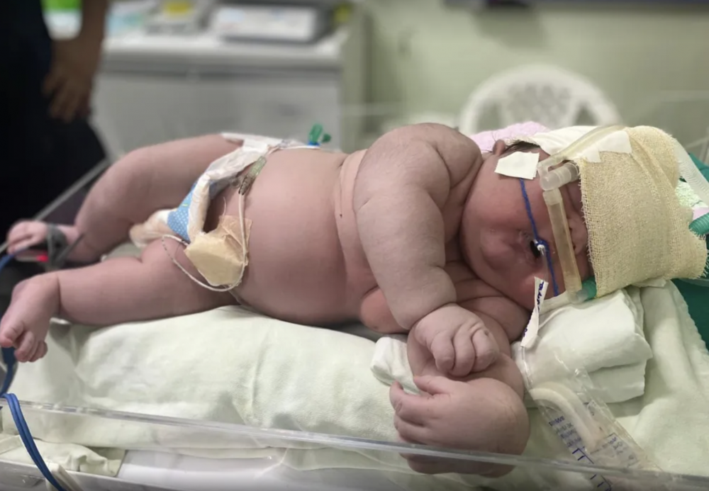 Angerson體重接近9個月大嬰兒。