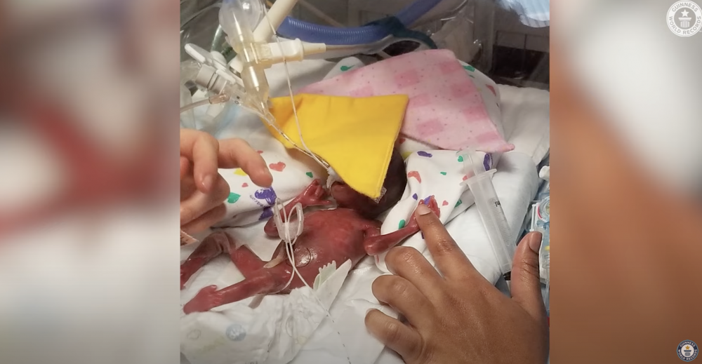 雙胞胎出世時非常脆弱。